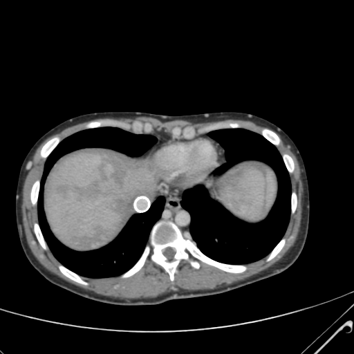File:Nutmeg liver- Budd-Chiari syndrome (Radiopaedia 46234-50635 B 6).png