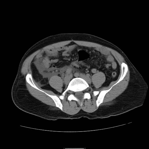 File:Obstructed kidney with perinephric urinoma (Radiopaedia 26889-27066 Axial non-contrast 44).jpg