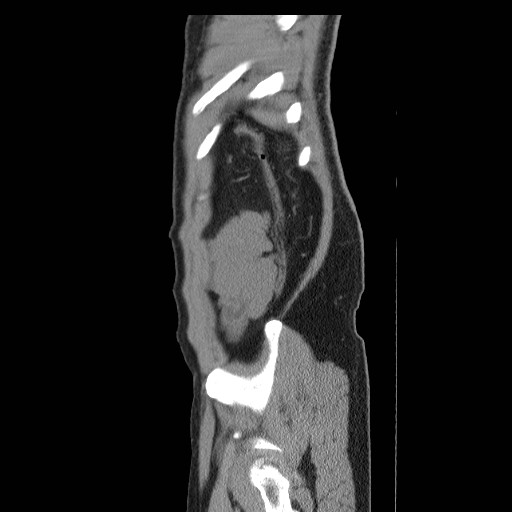 File:Obstructed kidney with perinephric urinoma (Radiopaedia 26889-27066 B 55).jpg