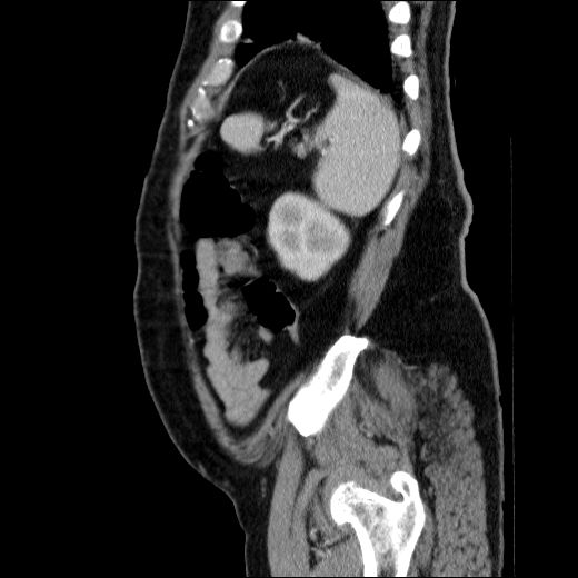 Obstructing ureteric calculus (Radiopaedia 49281-54373 C 21).jpg