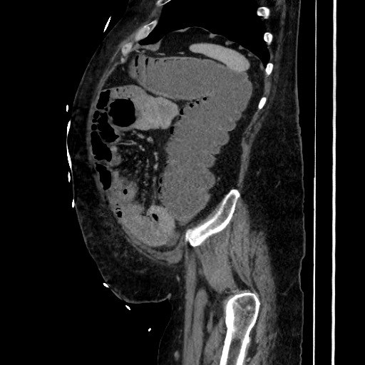 Obstructive colonic diverticular stricture (Radiopaedia 81085-94675 C 188).jpg