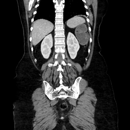 Obstructive distal colonic adenocarcinoma causing cecal perforation (Radiopaedia 86830-102989 C 133).jpg