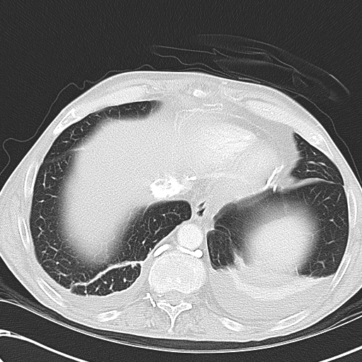 File:Obstructive superior vena cava tumor thrombus (Radiopaedia 28046-28306 Axial lung window 45).jpg