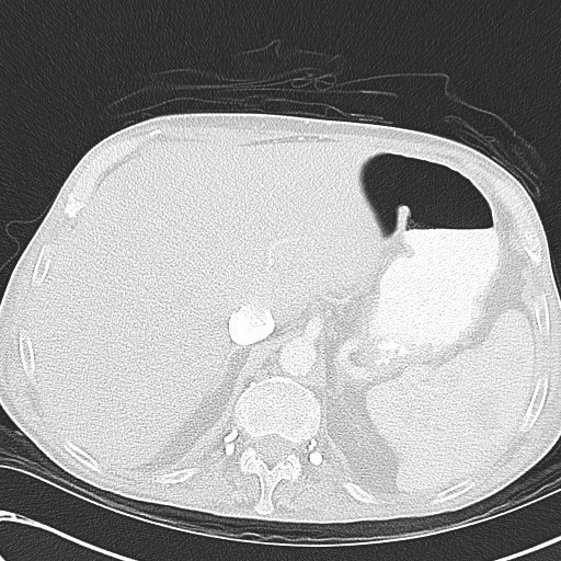 File:Obstructive superior vena cava tumor thrombus (Radiopaedia 28046-28306 Axial lung window 53).jpg