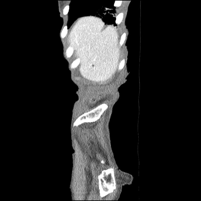Obturator hernia causing small bowel obstruction (Radiopaedia 65522-74612 C 89).jpg