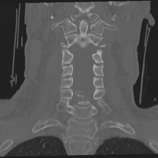 File:Occipital condyle fracture (Radiopaedia 33467-34517 Coronal bone window 31).png