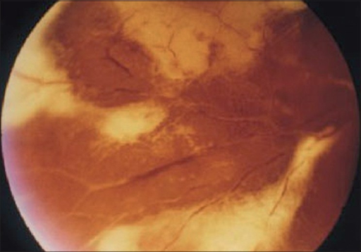File:PMC2636133 IndianJOphthalmol-56-377-g008.png