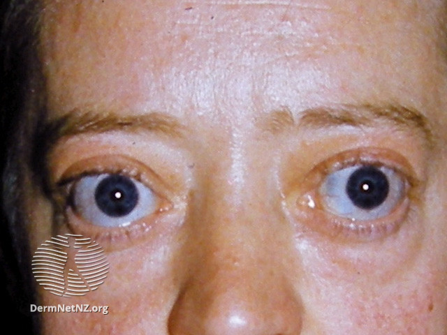 File:Thyroid ophthalmopathy (DermNet NZ systemic-hyperthyroidism-7).jpg