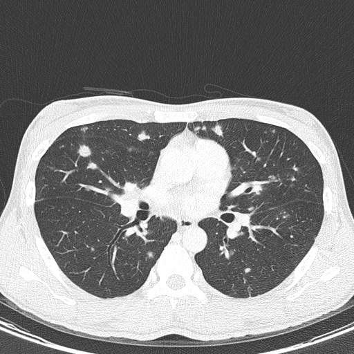 AIDS-related Kaposi sarcoma (Radiopaedia 85247-100811 Axial lung window 83).jpg