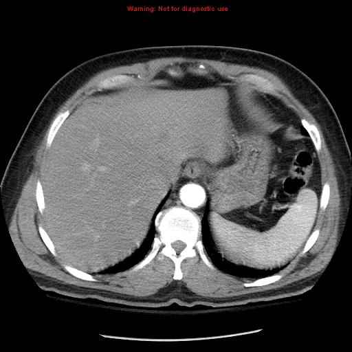 File:Abdominal aortic aneurysm (Radiopaedia 8190-9038 Axial C+ arterial phase 12).jpg