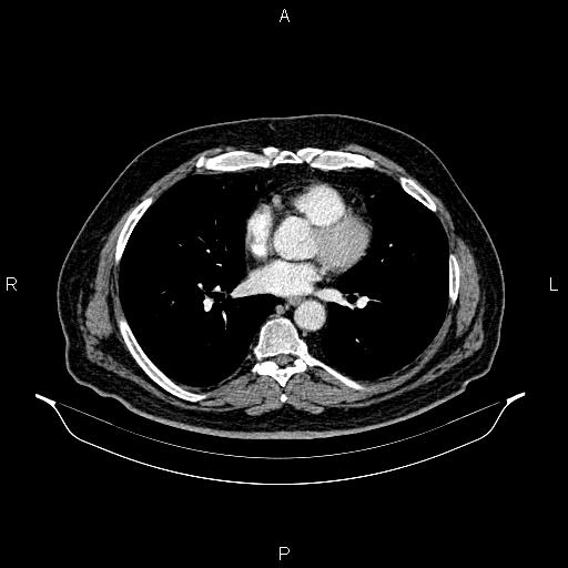 Abdominal aortic aneurysm (Radiopaedia 83094-97462 Axial renal cortical phase 45).jpg