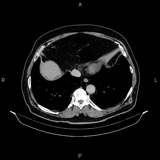 Abdominal aortic aneurysm (Radiopaedia 83094-97462 Axial renal excretory phase 12).jpg