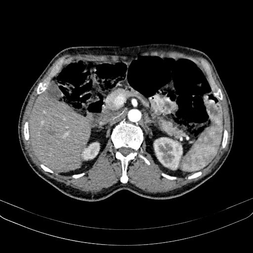 Abdominal aortic aneurysm (Radiopaedia 83581-98689 Axial C+ arterial phase 42).jpg
