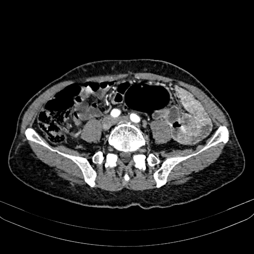 Abdominal aortic aneurysm (Radiopaedia 83581-98689 Axial C+ arterial phase 79).jpg
