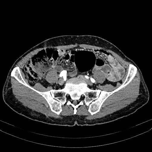 Abdominal aortic aneurysm (Radiopaedia 83581-98689 Axial C+ arterial phase 85).jpg
