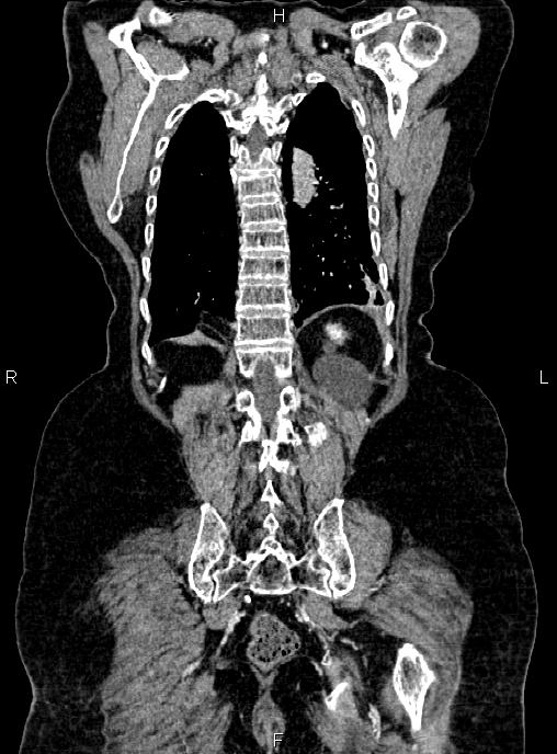 Abdominal aortic aneurysm (Radiopaedia 85063-100606 Coronal C+ arterial phase 49).jpg