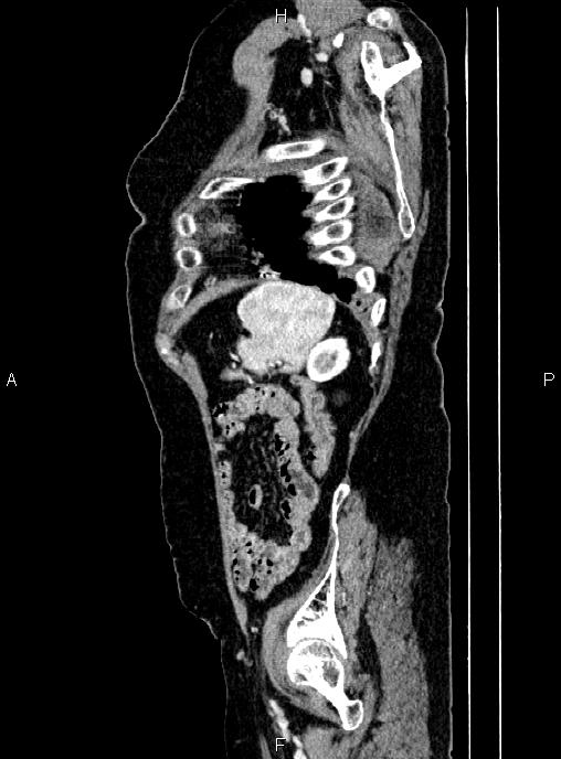 Abdominal aortic aneurysm (Radiopaedia 85063-100606 Sagittal C+ arterial phase 70).jpg