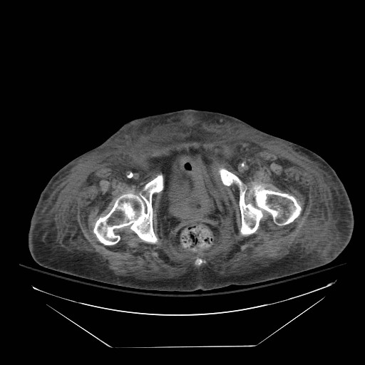 Abdominal aortic aneurysm - impending rupture (Radiopaedia 19233-19247 Axial non-contrast 160).jpg