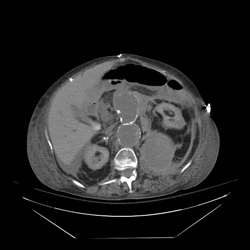 Abdominal aortic aneurysm - impending rupture (Radiopaedia 19233-19247 Axial non-contrast 69).jpg