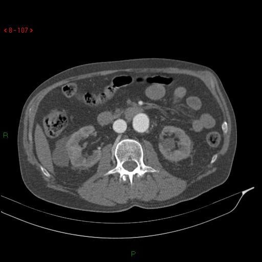 File:Abdominal aortic aneurysm rupture with aortocaval fistula (Radiopaedia 14897-14841 Axial C+ arterial phase 107).jpg