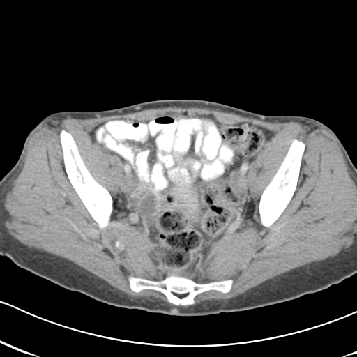 Abdominal desmoid tumor (Radiopaedia 41007-43740 Axial C+ portal venous phase 60).png