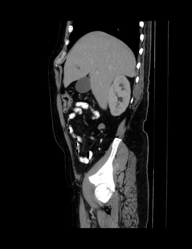 Abdominal lymphoma - with sandwich sign (Radiopaedia 53486-59492 Sagittal C+ portal venous phase 60).jpg