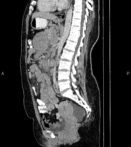 Abdominal lymphoma with sandwich sign (Radiopaedia 84378-99704 Sagittal C+ portal venous phase 46).jpg