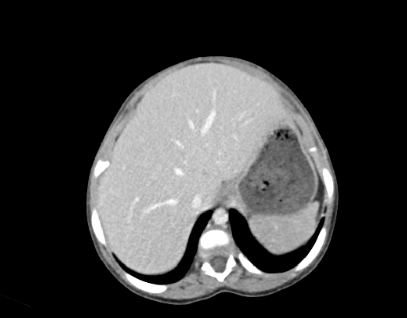Abdominal premesenteric cystic lymphangioma (Radiopaedia 82995-97350 Axial C+ portal venous phase 6).jpg