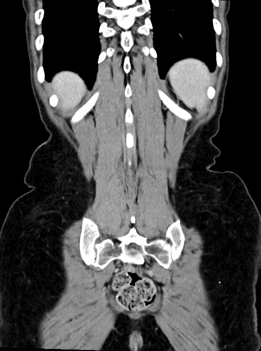 Abdominal wall and retroperitoneal tuberculosis (Radiopaedia 88137-104729 Coronal C+ portal venous phase 88).jpg