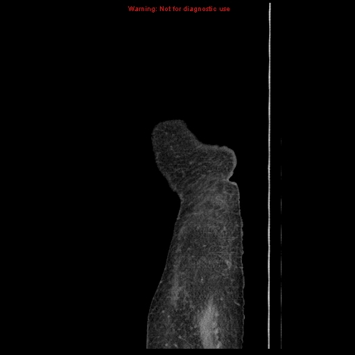 Abdominal wall hematoma (Radiopaedia 9427-10112 Sagittal C+ portal venous phase 3).jpg