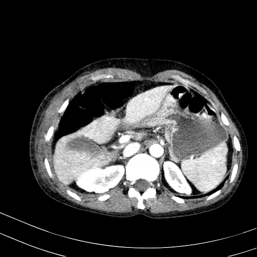 Abdominal wall hematoma with active bleeding (Radiopaedia 83915-99117 Axial renal cortical phase 4).jpg