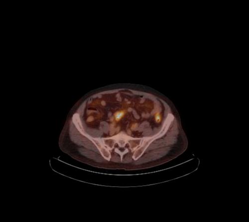 Abdominal wall metastasis from colorectal carcinoma (Radiopaedia 31016-31719 C 42).jpg
