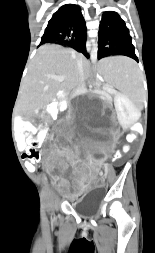 Abdominopelvic rhabdomyosarcoma (Radiopaedia 78356-90984 Coronal C+ portal venous phase 56).jpg