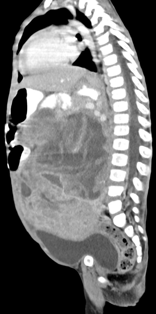 Abdominopelvic rhabdomyosarcoma (Radiopaedia 78356-90984 Sagittal C+ portal venous phase 41).jpg