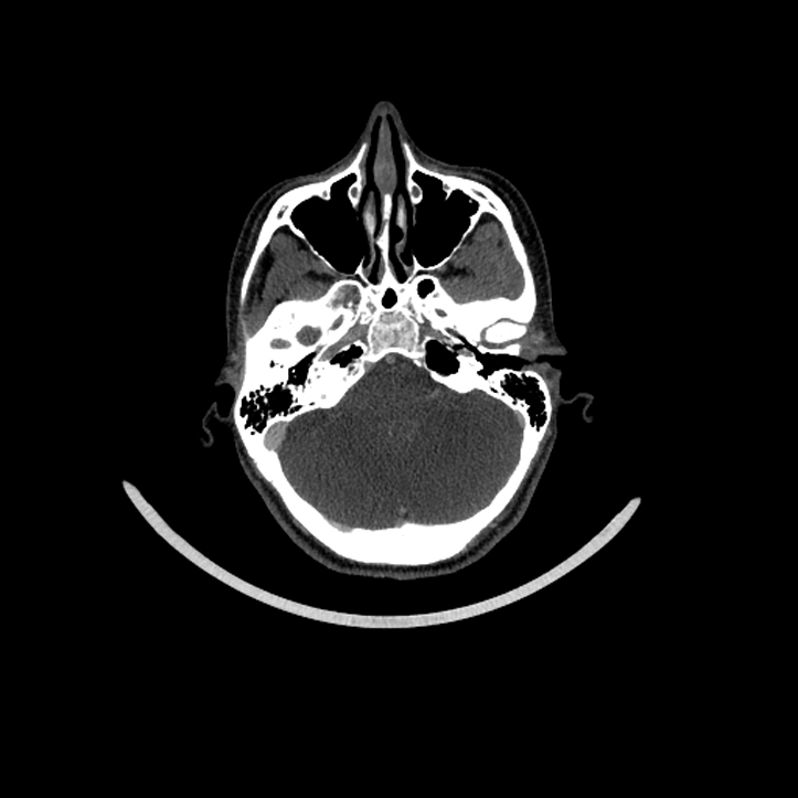 Aberrant right internal carotid artery (Radiopaedia 65191-74197 Axial C+ arterial phase 42).jpg
