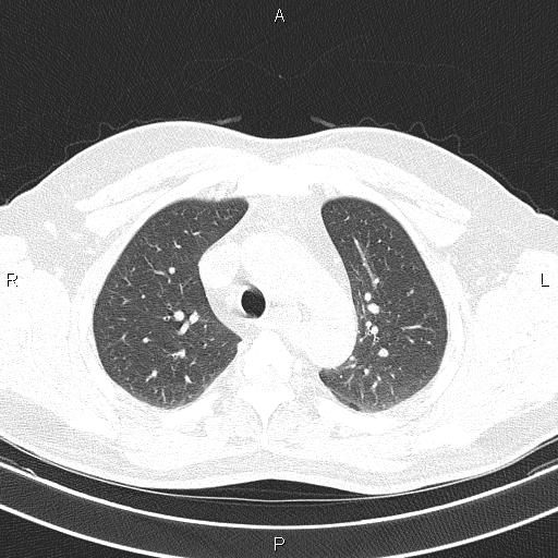 Aberrant right subclavian artery (Radiopaedia 87093-103354 Axial lung window 32).jpg