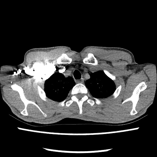 Accessory left horizontal fissure with lingular pneumonia (Radiopaedia 53763-59843 Axial C+ CTPA 15).jpg