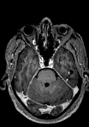 Accessory middle cerebral artery (Radiopaedia 73114-83828 Axial T1 C+ 105).jpg