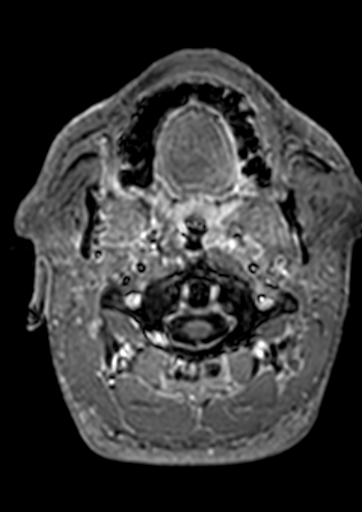 Accessory middle cerebral artery (Radiopaedia 73114-83828 Axial T1 C+ 219).jpg