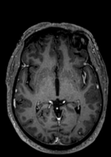 File:Accessory middle cerebral artery (Radiopaedia 73114-83828 Axial T1 C+ 47).jpg