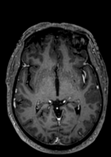 File:Accessory middle cerebral artery (Radiopaedia 73114-83828 Axial T1 C+ 48).jpg