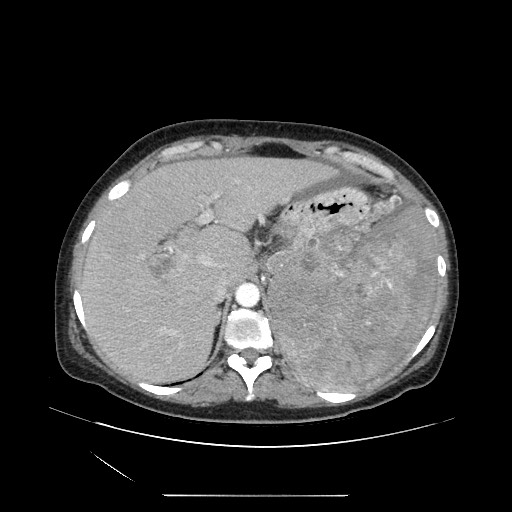 Acinar cell carcinoma of the pancreas (Radiopaedia 75442-86669 Axial C+ portal venous phase 29).jpg