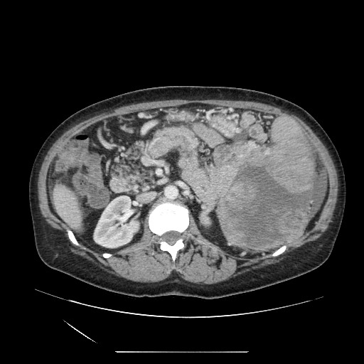 File:Acinar cell carcinoma of the pancreas (Radiopaedia 75442-86669 Axial C+ portal venous phase 58).jpg