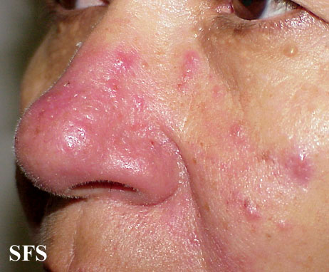 Acne Rosacea (Dermatology Atlas 16).jpg