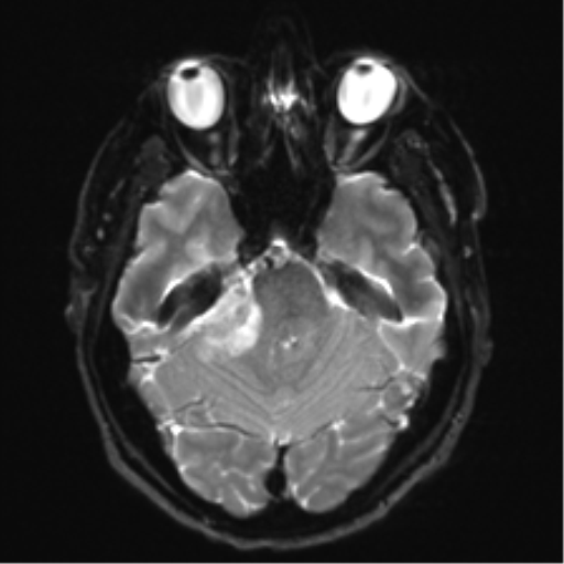 Acoustic schwannoma (Radiopaedia 50846-56358 Axial DWI 9).png