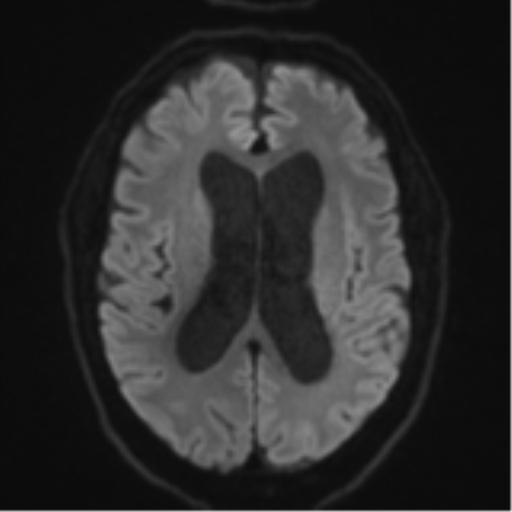 Acoustic schwannoma (Radiopaedia 55729-62281 E 43).png