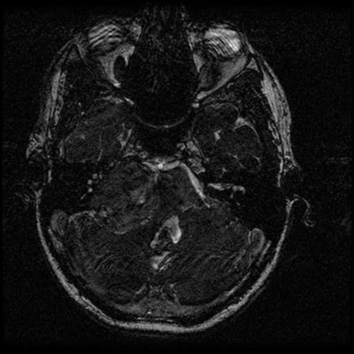 Acoustic schwannoma - eroding petrous apex (Radiopaedia 39674-42004 Axial T2 38).png