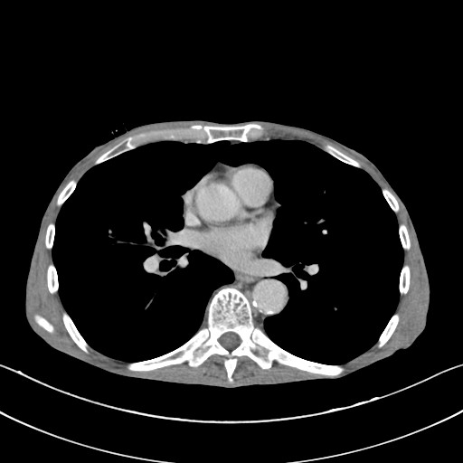 File:Acquired tracheoesophageal fistula (Radiopaedia 57747-65042 Axial C+ portal venous phase 55).jpg