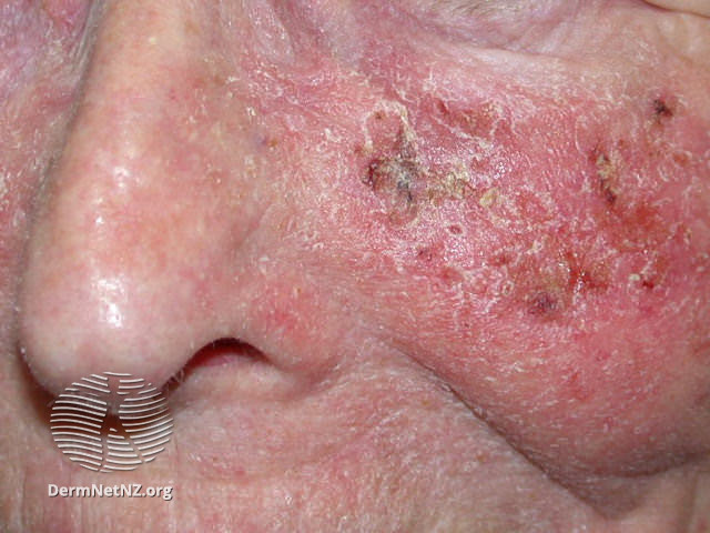 File:Actinic Keratoses treated with imiquimod (DermNet NZ lesions-ak-imiquimod-3742).jpg