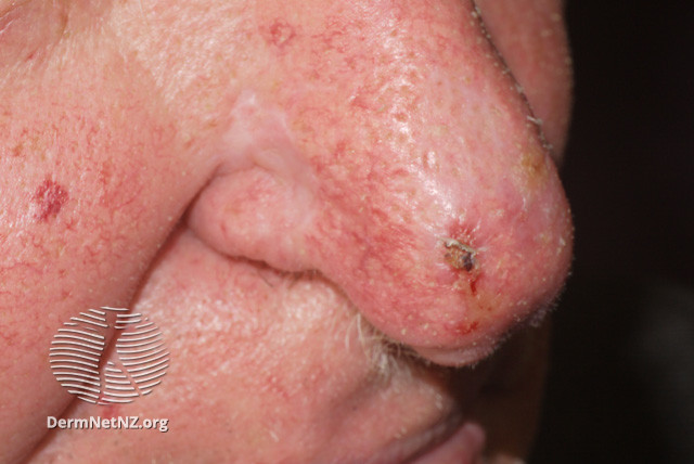 File:Actinic keratoses on the nose (DermNet NZ lesions-sks-nose3).jpg